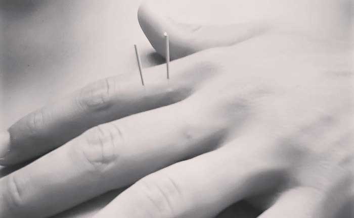 All About Acupuncture information education