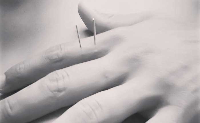 All about acupuncture